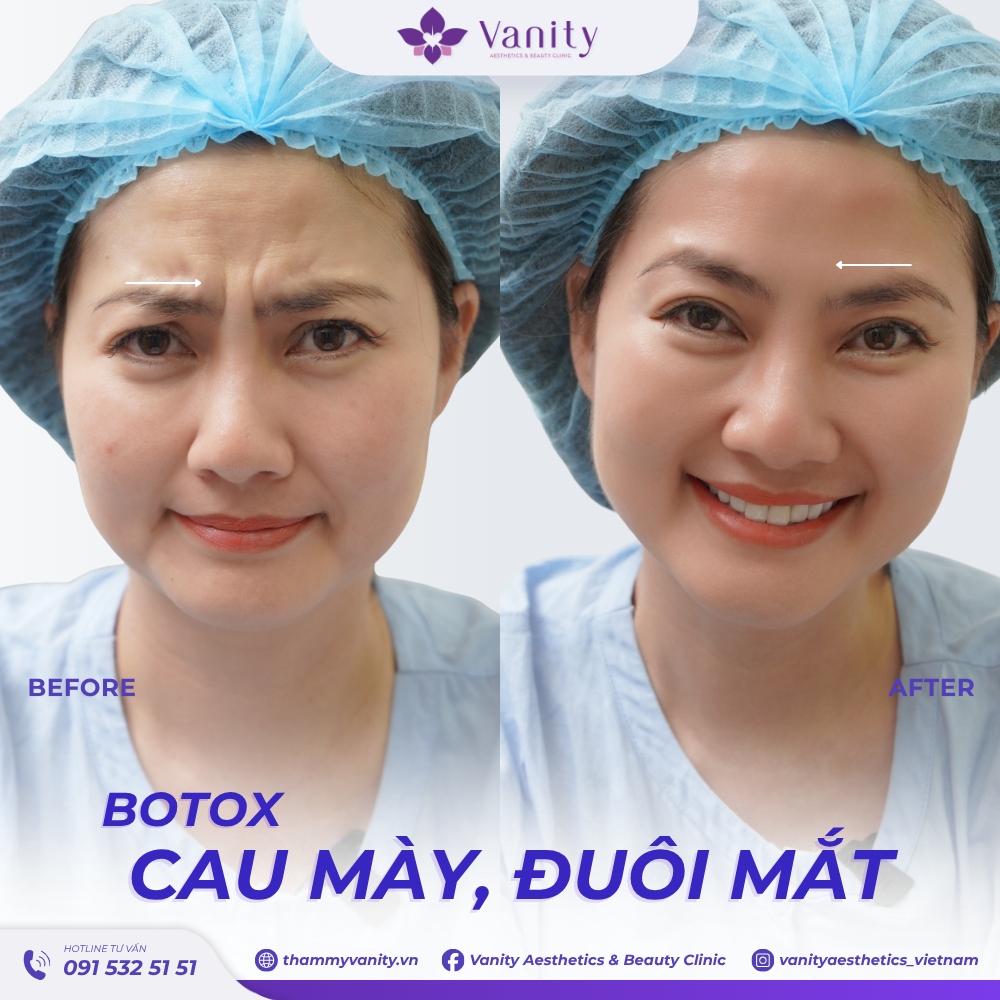 BOTOX CAU MÀY, ĐUÔI MẮT